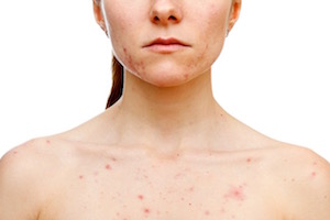Skin picking disorder awareness with treatment options, self-help strategies, and healing skin